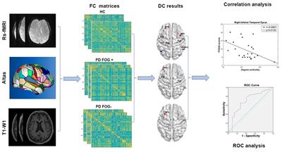 Altered Degree Centrality of Brain Networks in Parkinson's Disease With Freezing of Gait: A Resting-State Functional MRI Study